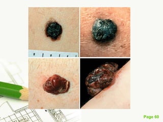 Melanoma (malignant melanoma)