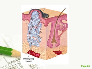 Melanoma (malignant melanoma)