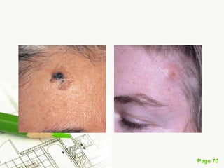 Melanoma (malignant melanoma)