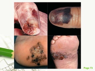 Melanoma (malignant melanoma)