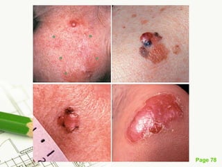 Melanoma (malignant melanoma)