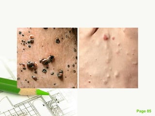 Melanoma (malignant melanoma)