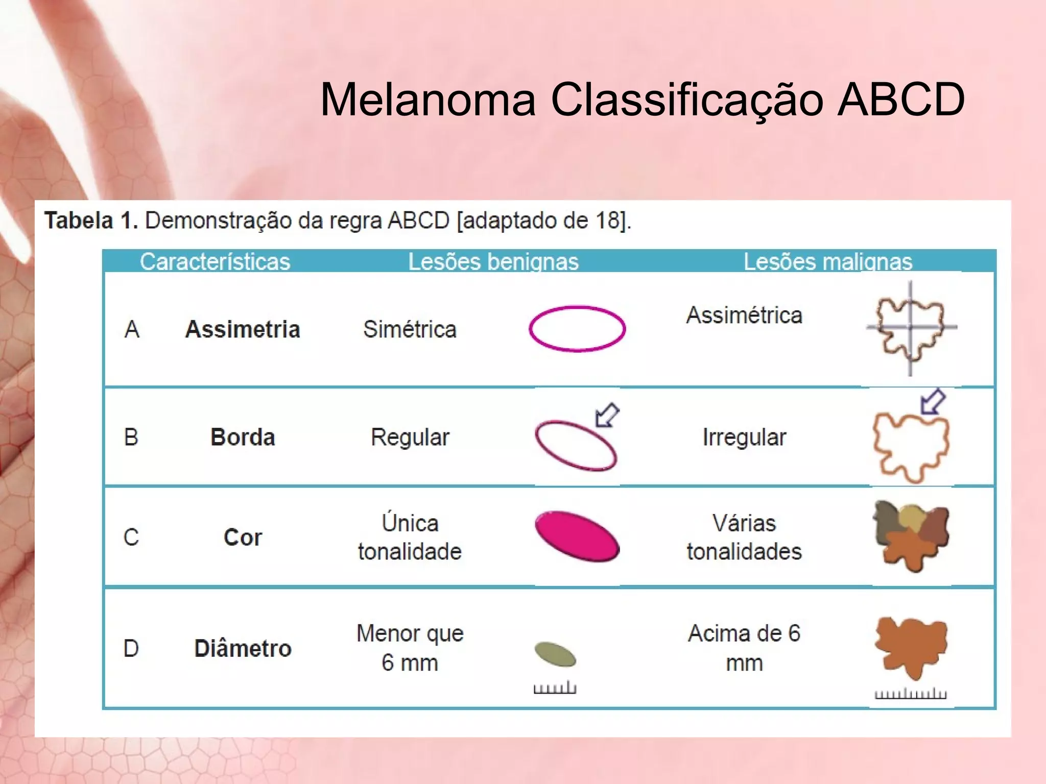 Melanoma classificação ABCD