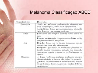 Melanoma Classificação ABCD | PPT