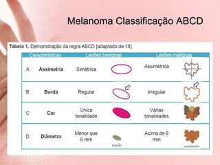 Melanoma Classificação ABCD | PPT