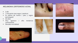 Melanoma maligno diagnostico y tratamiento .pdf