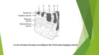 A Skin Cancer Overview, Understanding Melanoma Cancer , Causes ...