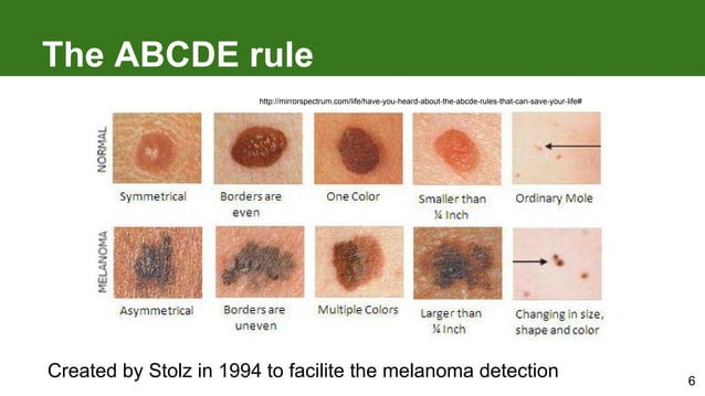 Melanoma: how to detect skin cancer | PDF | Cancer | Diseases and ...