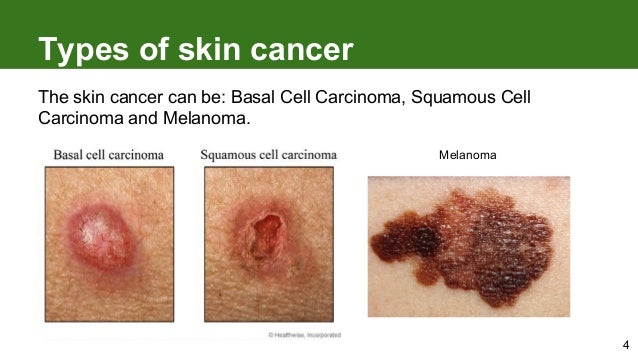 4 Types Of Skin Cancer