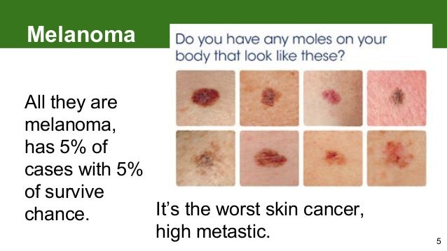 How do you identify melanoma?