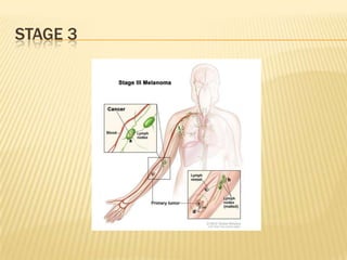 STAGE 3
 