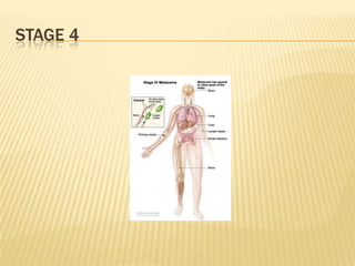 STAGE 4
 
