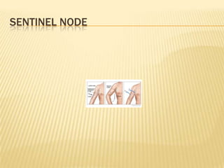 SENTINEL NODE
 