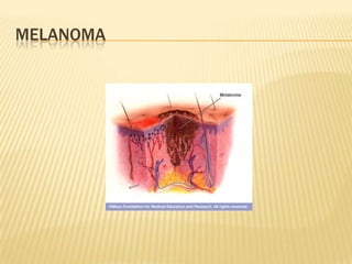 MELANOMA
 