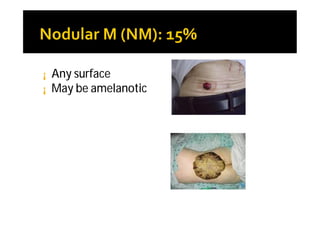 ¡   Any surface
¡   May be amelanotic
 