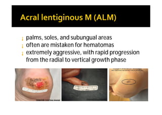 ¡   palms, soles, and subungual areas
¡   often are mistaken for hematomas
¡   extremely aggressive, with rapid progression
    from the radial to vertical growth phase
 