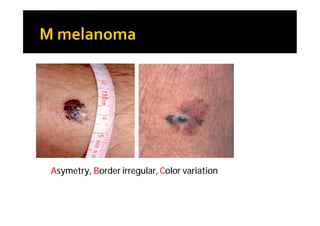 Asymetry, Border irregular, Color variation
 