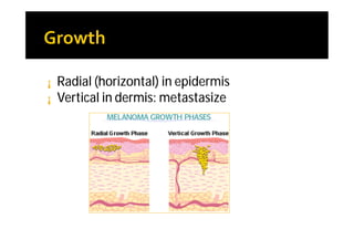 ¡   Radial (horizontal) in epidermis
¡   Vertical in dermis: metastasize
 