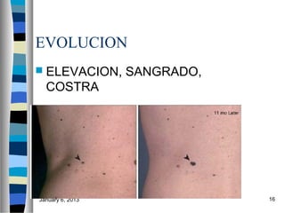 EVOLUCION
 ELEVACION,      SANGRADO,
  COSTRA




January 6, 2013               16
 