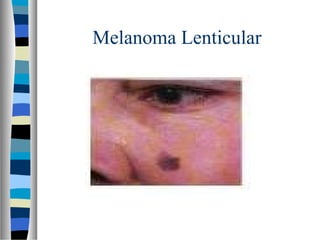 Melanoma Lenticular
 