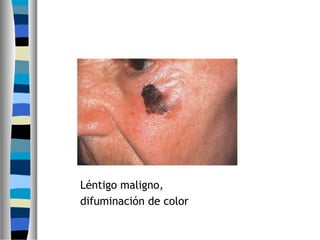 Léntigo maligno,
difuminación de color
 