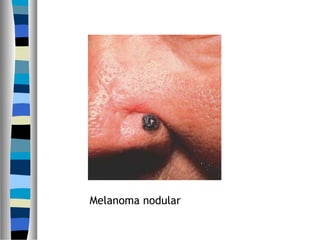 Melanoma nodular
 