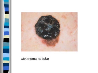 Melanoma nodular
 