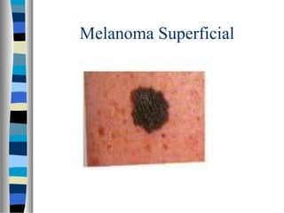 Melanoma Superficial
 