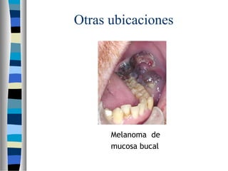 Otras ubicaciones




      Melanoma de
      mucosa bucal
 