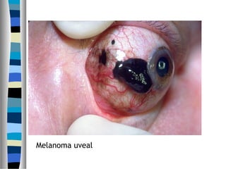 Melanoma uveal
 