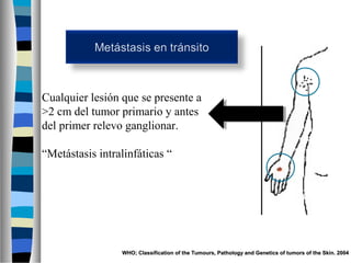 Cualquier lesión que se presente a
>2 cm del tumor primario y antes
del primer relevo ganglionar.

“Metástasis intralinfáticas “




                 WHO; Classification of the Tumours, Pathology and Genetics of tumors of the Skin. 2004
 