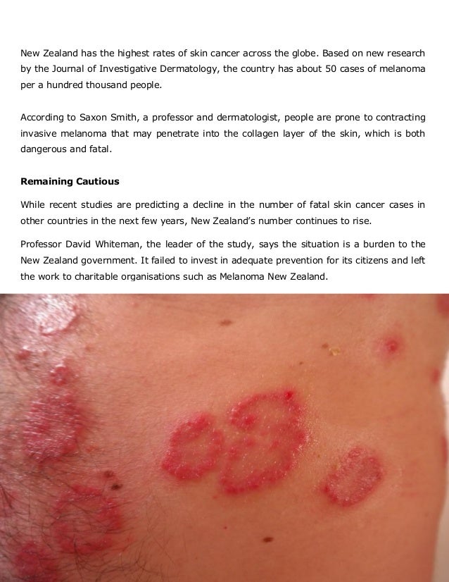 Melanoma Cases, Still a Cause for Concern in New Zealand