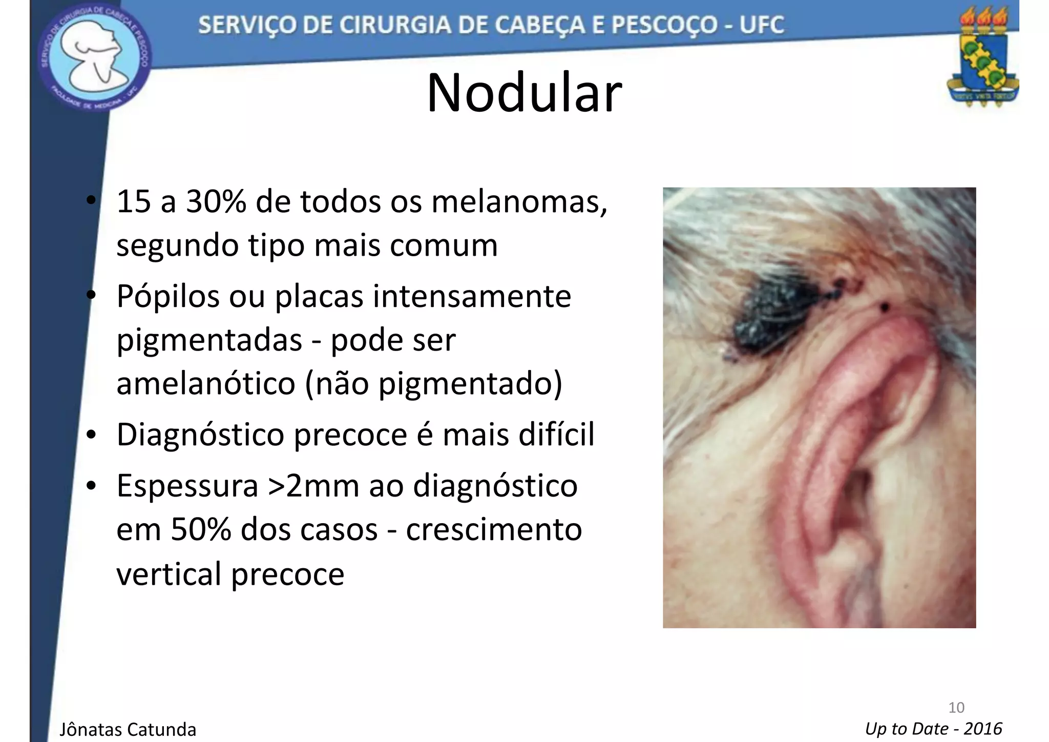 melanoma-em-cabe-a-e-pesco-o-ppt
