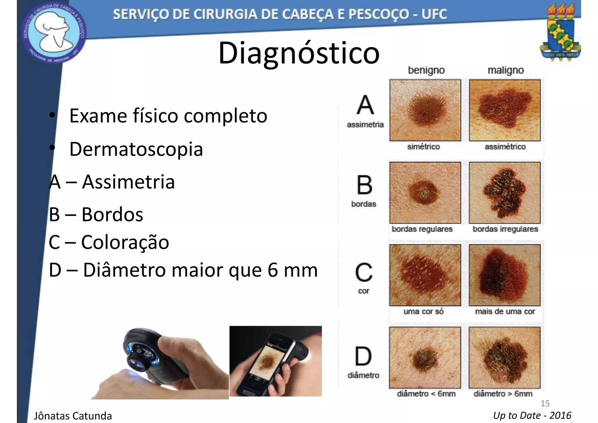 melanoma-em-cabe-a-e-pesco-o-ppt