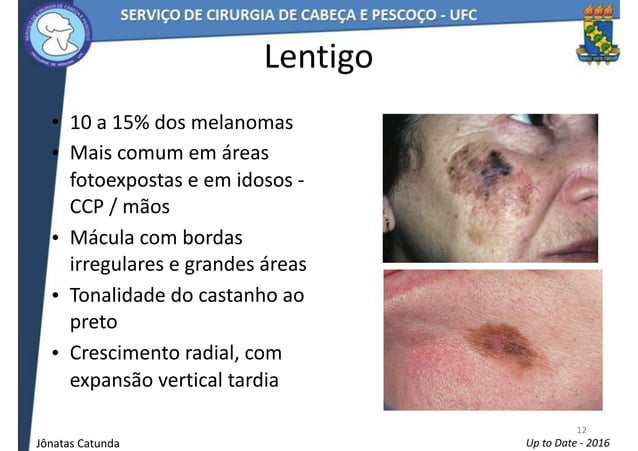 melanoma-em-cabe-a-e-pesco-o-ppt