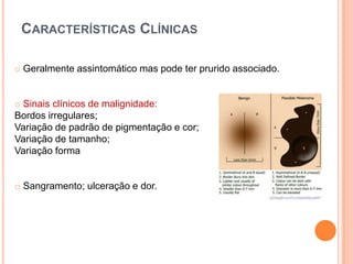 Frequentemente delectado nos melanomas