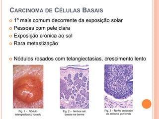 Carcinoma de Células Basais1º mais comum decorrente da exposição solarPessoas com pele claraExposição crónica ao solRara metastizaçãoNódulos rosados com telangiectasias, crescimento lentoFig. 3 – Ninho separado do estroma por fenda Fig. 1 –  Nódulo telangiectásico rosadoFig. 2 –  Ninhos cél. basais na derme