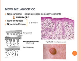 Dermoscopia (microscopia de epiluminescência)