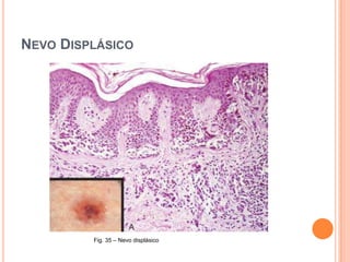  Biópsia excisional ou incisionalEstadiamentoClassificação AJCC: Sistema TMN