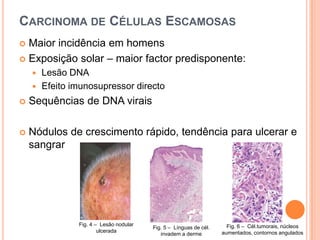 Carcinoma de Células EscamosasMaior incidência em homensExposição solar – maior factor predisponente:Lesão DNAEfeito imunosupressor directoSequências de DNA viraisNódulos de crescimento rápido, tendência para ulcerar e sangrarFig. 4 –  Lesão nodular  ulceradaFig. 6 –  Cél.tumorais, núcleos aumentados, contornos anguladosFig. 5 –  Línguas de cél. invadem a derme