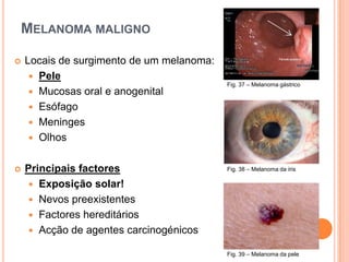 Prevenção Baseia-se na protecção solar:	Protector solar com FPS ≥15	Uso de roupas protectoras	Evitar exposição ultravioleta intensa entre 	10-16H	Evitar exposição por horas excessivas Informação sobre risco hereditário e conhecimentos básicos de sinais de perigo.