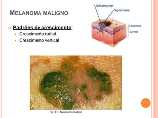  Cuidado com fármacos que aumentam sensibilidade aos efeitos do sol.Prevenção – Detecção Precoce“ABCD Rules”AssimetriaBordosCorDiâmetro