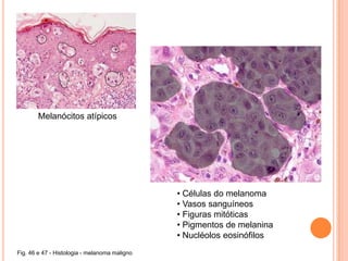 Epiderme - MelanócitosFig. 22 – Melanócitos na epiderme.Fig. 21 – Estrutura de um melanócito.
