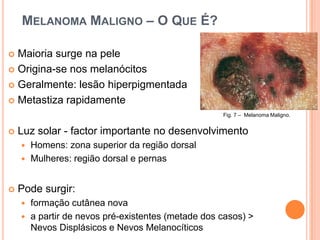 Melanoma Maligno – O Que É?Maioria surge na peleOrigina-se nos melanócitosGeralmente: lesão hiperpigmentadaMetastiza rapidamenteLuz solar - factor importante no desenvolvimentoHomens: zona superior da região dorsalMulheres: região dorsal e pernasPode surgir:formação cutânea novaa partir de nevos pré-existentes (metade dos casos) > Nevos Displásicos e Nevos MelanocíticosFig. 7 –  Melanoma Maligno.