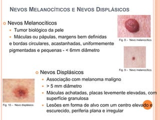 Nevos Melanocíticos e Nevos DisplásicosNevos MelanocíticosTumor biológico da peleMáculas ou pápulas, margens bem definidas e bordas circulares, acastanhadas, uniformementepigmentadas e pequenas - < 6mm diâmetroFig. 8 –  Nevo melanocítico.Fig. 9 –  Nevo melanocítico.Nevos Displásicos