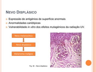 Estadiamento - MetastizaçãoMetastizaçãoImageamento de possiveis locais