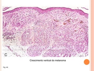 Pele – estrutura histológicaEpidermeDermeHipodermeFig. 17 – Corte histológico da pele.Fig. 16 – Estrutura da pele.