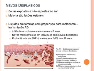 Associação com melanoma maligno