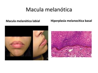 macula melanotica boca Qué significa la aparición de manchas negras en la boca?