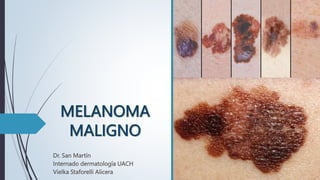 MELANOMA
MALIGNO
Dr. San Martín
Internado dermatología UACH
Vielka Staforelli Alicera
 